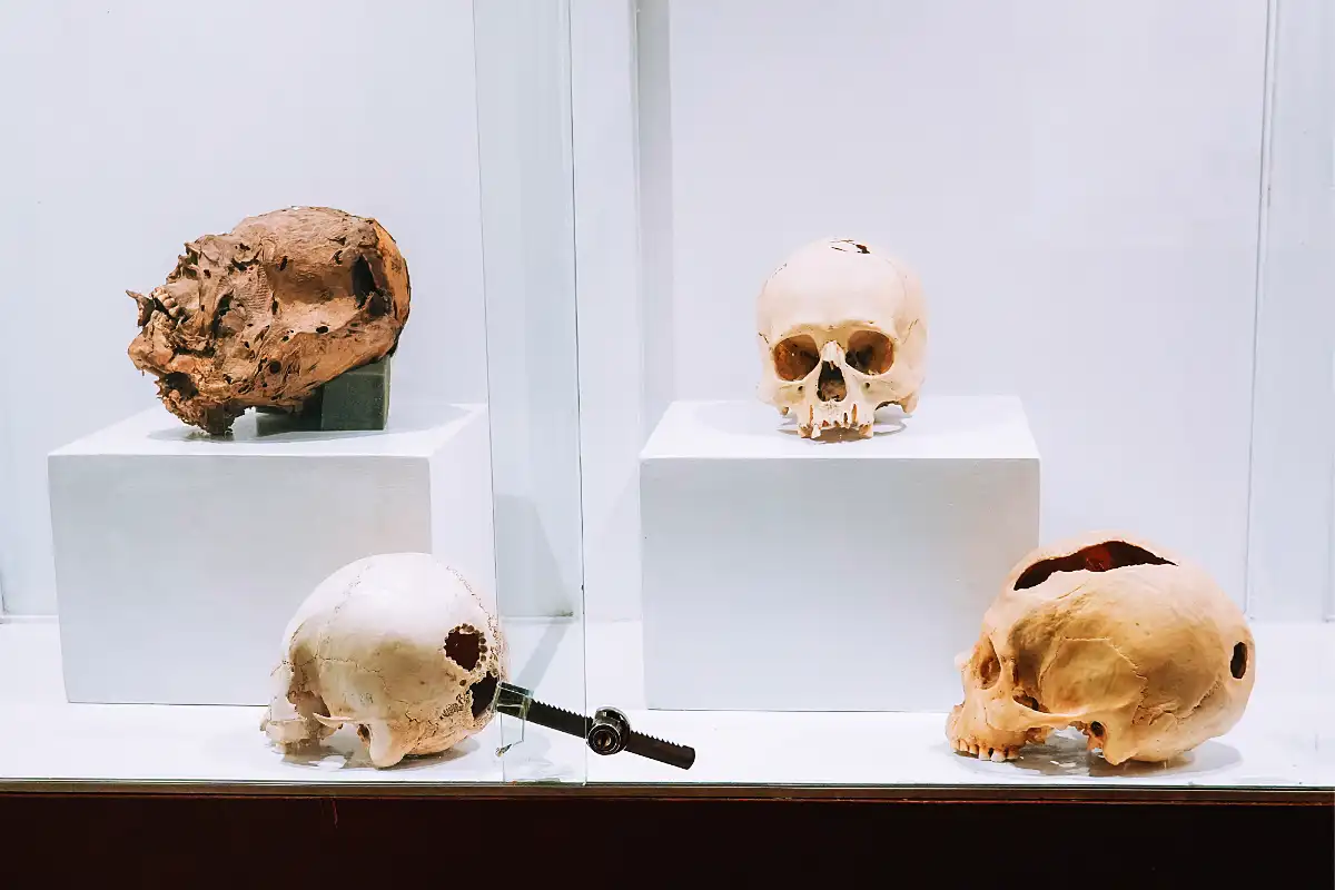 Paracas Cranial Trepanation | TreXperience Paracas Cranial Trepanation | TreXperience